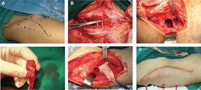 Pedicled iliac bone flap grafting in the treatment of late presentation Legg–Calvé–Perthes disease